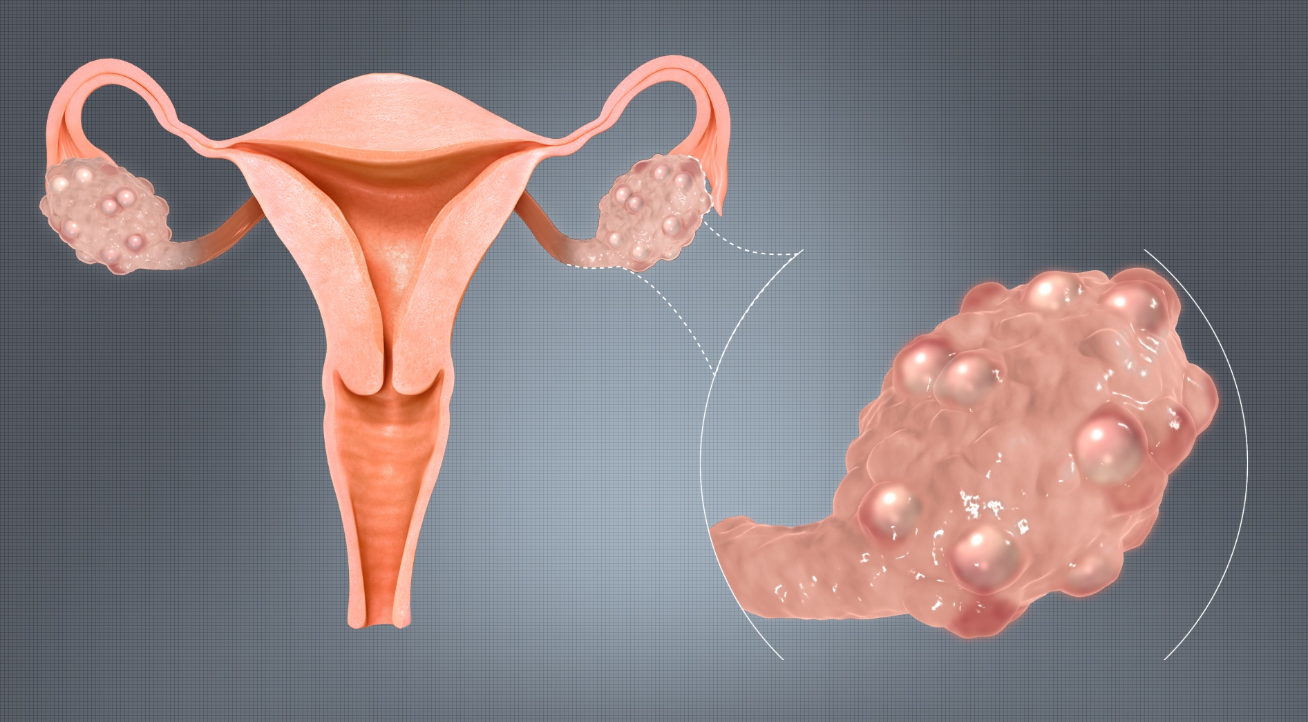 Polycisticke ovaria na vaječníkoch pcos Polycisticke ovaria na vaječníkoch pcos